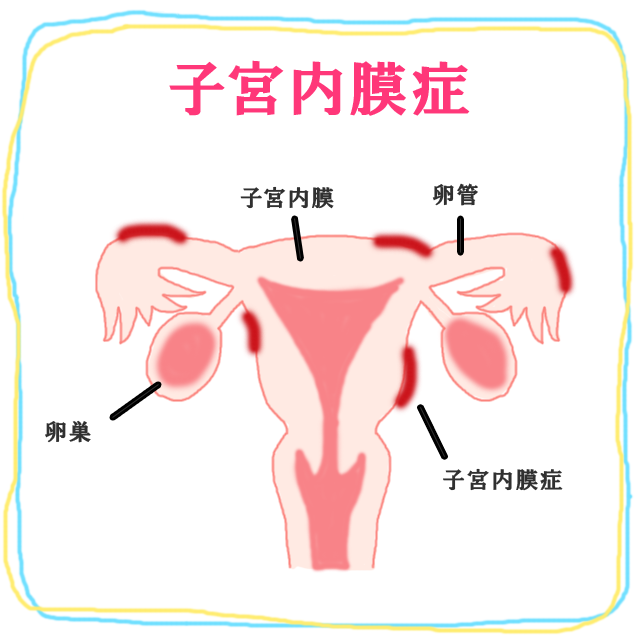 金澤朋子が診断された子宮内膜症とは……？