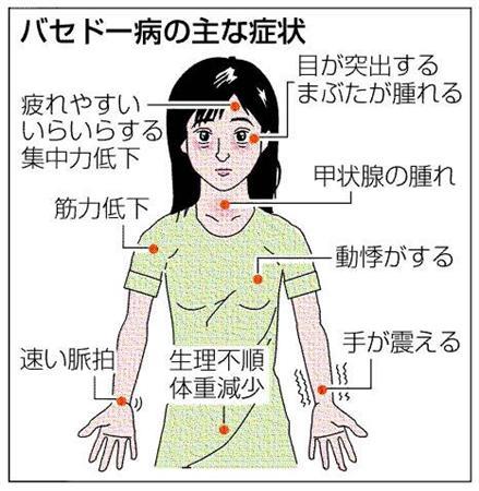 絢香が患ったバセドウ病とはどんな病気？