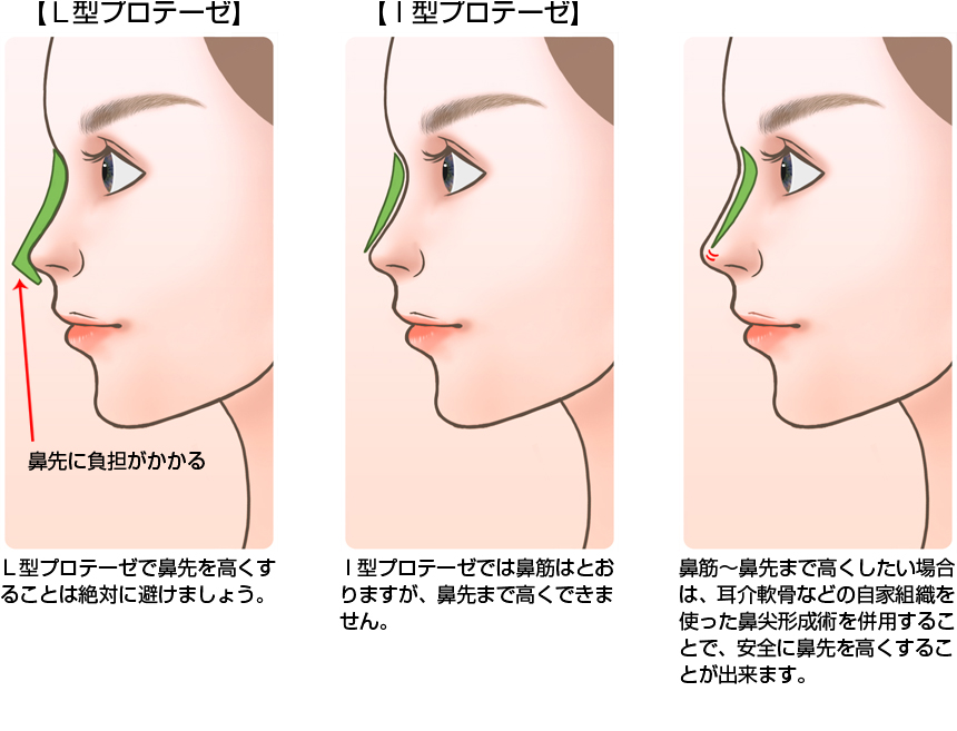 KEIKOの鼻の異変はプロテーゼが原因！？