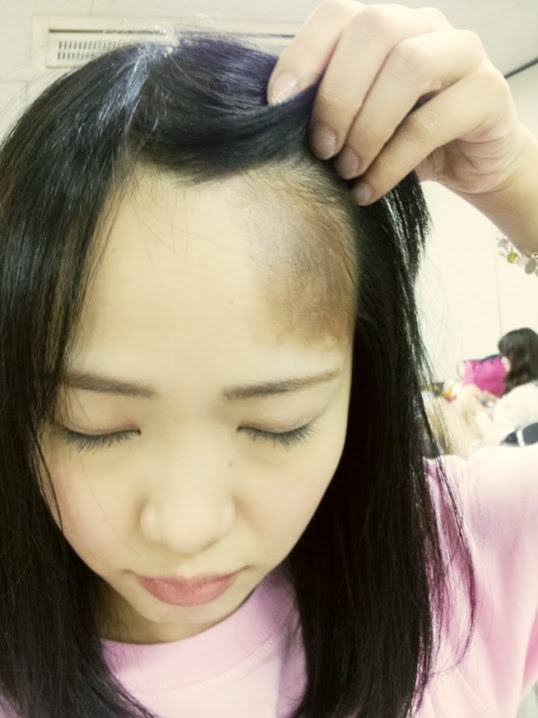 ハゲ 松村香織の髪が薄毛に 高須クリニックで治療した結果 画像多数 Aikru アイクル かわいい女の子の情報まとめサイト