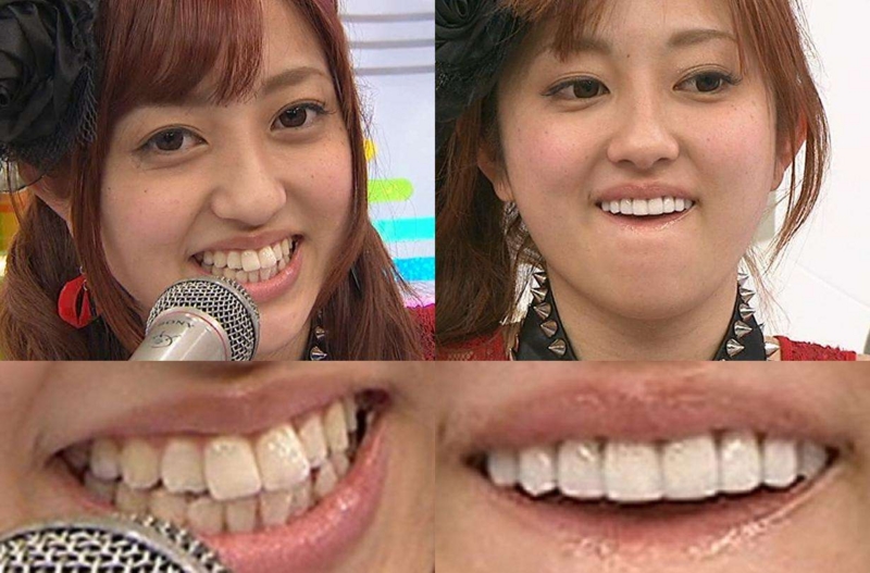 菊地亜美が歯列矯正 舌の裏の手術 画像と現在まとめ Aikru アイクル かわいい女の子の情報まとめサイト