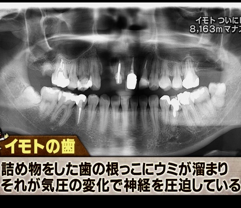 イモトアヤコの歯のレントゲン画像（27歳当時）